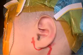 3岁小女孩的左侧腮腺肿块图片