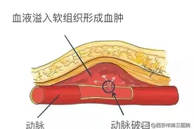 神经介入︱股动脉假性动脉瘤图片