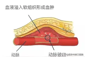 神经介入︱股动脉假性动脉瘤图片