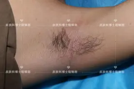 案例分享：19岁男生遗传狐臭，因为当兵前来治疗图片