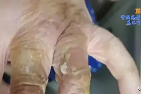 肾病患者爱戴戒指，真不可“取”图片