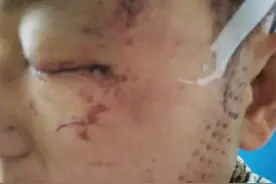 何苦！兄弟争宅基地，弟弟：亲哥举镐头打我，嫂子抠瞎我眼睛图片