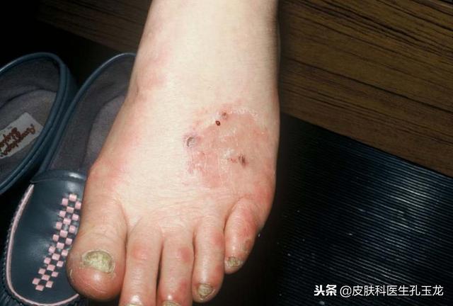 脚真菌感染角化