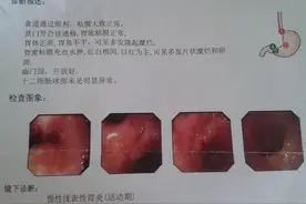 胃疼吐酸水、烧心、嗳气、口臭，1剂中药方，老中医调养脾胃图片