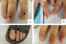 孩子突然指甲变白、脱落，这是怎么了？该如何处理？图片