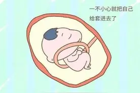 常见的胎儿脐带绕颈，别慌，专业医生教你看懂它图片