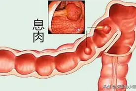 医生提醒：肠息肉切除后，饮食上做到这几点，伤口好得更快图片
