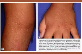 玩沙土后娃手上长满小疙瘩？热水烫、盐水洗都没用！这样做……图片