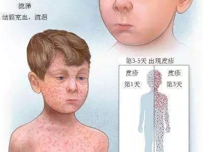 8岁女孩脸部有毛囊角化丘疹