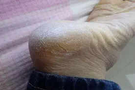 脚后跟经常干裂起皮？营养师：未必是缺乏维生素，可能在说明问题图片