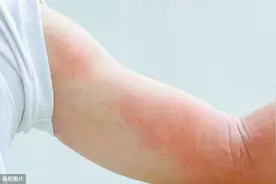 身上起了“风疙瘩”又痒又肿，想快速消退，1种药或值得一试图片