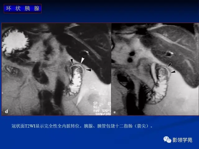 胰腺的解剖与常见变异