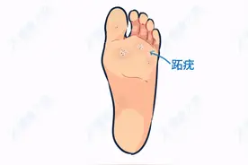脚底长鸡眼，挖了又长怎么办？学会4招，鸡眼不再是困扰图片