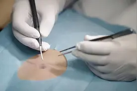 郝医生祛痣攻略｜手术切痣一定会留疤吗？图片