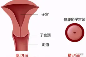 LEEP手术知多少？图片