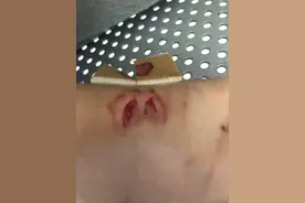 习惯了溺爱放纵，四岁比格犬疯狂护食，主人被它咬出2个巨大血洞图片