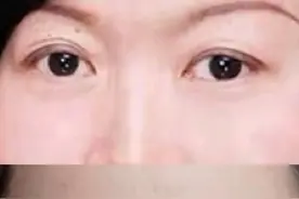 双眼皮整成大小眼，艺龄医院：手术医生已离职，资料已被老鼠咬坏图片