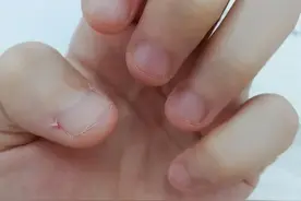 看着都疼！指甲没剪对，宝宝的手竟变成这样图片