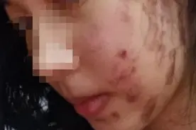 姑娘做完“光子嫩肤”后，脸上全是黑疤，美容师还说“很正常”？图片
