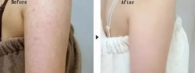 鸡皮肤治疗神器