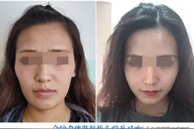 想去做"脂肪填充"，心里担心？医生与你说几句真心话图片