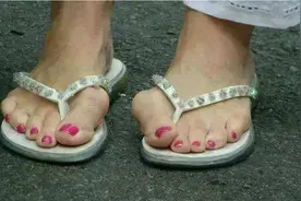 助你踏稳脚步——大脚骨必须手术吗？图片