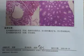 46岁女士肠息肉切除后，3年不查，拖出晚期肠癌图片