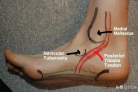你不知道的脚踝内侧疼痛图片