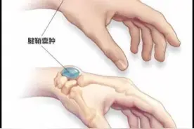 健康·科普 | 带你了解什么是腱鞘囊肿图片