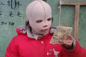 9岁女孩整天戴“面具”示人，受同龄人嘲笑，可摘下之后让人落泪图片