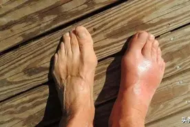 420高尿酸日：痛风发作时如何选择止痛药图片