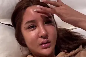 23岁网红整容出现后遗症，脸部浮肿额头凹陷，曾在6年内花费百万图片