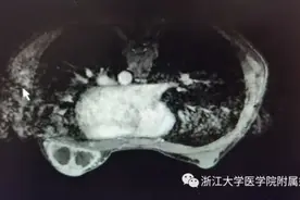 胸部肿块没在意，11岁女孩乳腺脓肿坏死！哺乳期女性的高发病为何年轻姑娘也会得？图片