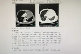6小时30分，切除巨大肿瘤切图片