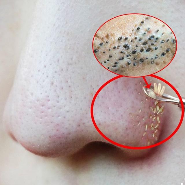 6娆惧崠鐤簡鐨勯櫎铻ㄧ殏姣旀嫾锛侀櫎铻ㄧ殏鐪熺殑鑳介櫎铻ㄥ悧锛熻繕鏄蹇芥偁浜嗭紵