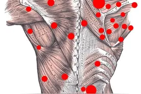 吗啡泵埋植技术治疗顽固性慢性疼痛图片