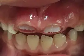 7岁孩子门牙掉了1年，一直长不出来，家长着急，该怎么办？图片