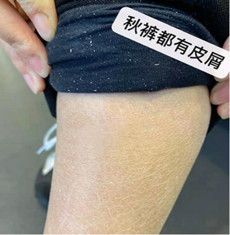 尿素身体乳含激素吗