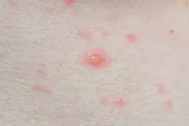 成人真的也会出水痘吗？图片