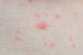 成人真的也会出水痘吗？图片