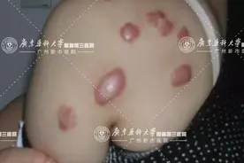 疼！痒！丑！不能掉以轻心的“疤痕疙瘩”图片