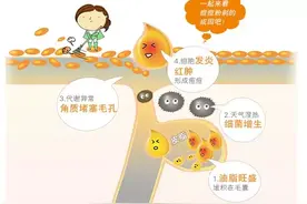 掌握这个方法，让你的痘痘如同开通小马达一样快速消失图片