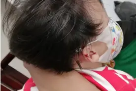 家里玩耍不慎摔倒，螺丝刀插入2岁女孩颅脑图片