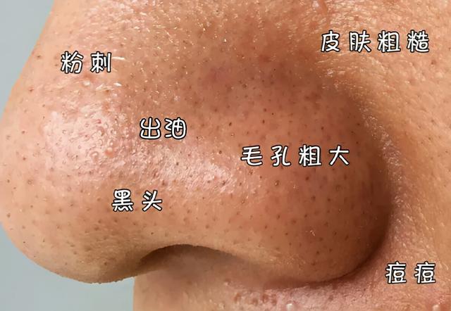 泥膜清洁面膜能去鸡皮肤吗