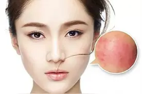 敏感肌肤脸上泛红详细解析，我们应该如何改善？图片