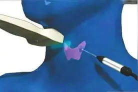 疗效、美观、微创，一个都不能少！甲状腺结节消融治疗图片