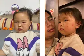 宝宝被蚊子咬，又肿又痒还留疤，该怎么处理？正确的方法要收藏图片