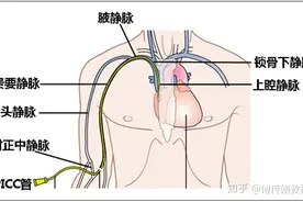 直肠癌治疗历程（四）图片