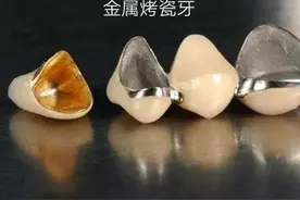做了烤瓷牙后，里面的基牙可以用多久？基牙烂掉概率是多少？图片