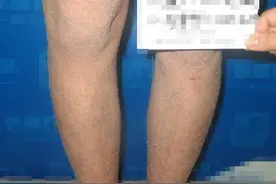 老公有鱼鳞病，我们差一点就离婚了图片